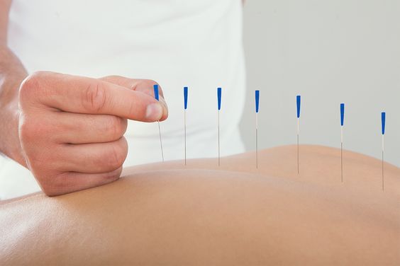 Dry needling- Redefined Physio in Kuala Lumpur (Physiotherapy)