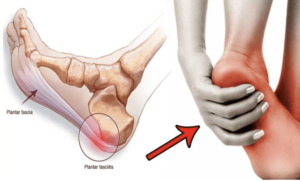 Plantar Fasciitis's image