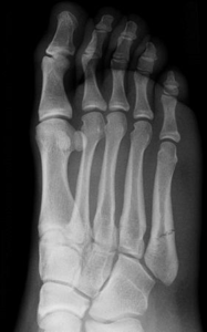 Ankle sprain's image