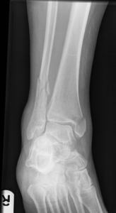 Ankle sprain's image