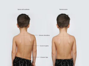 Sign of Scoliosis