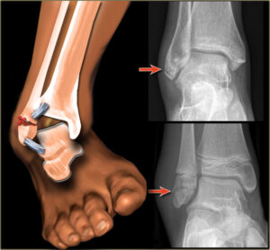 Ankle / foot fracture