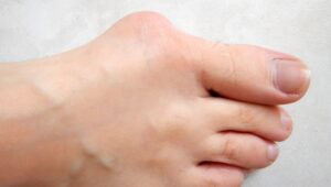 Bunion- Redefined Physiotherapy