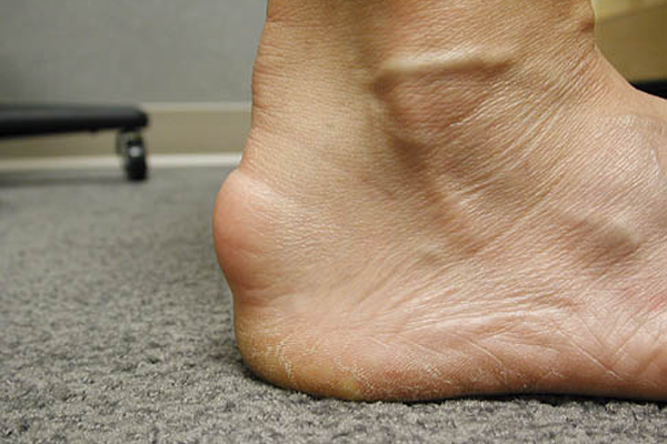 Achilles Tendinitis