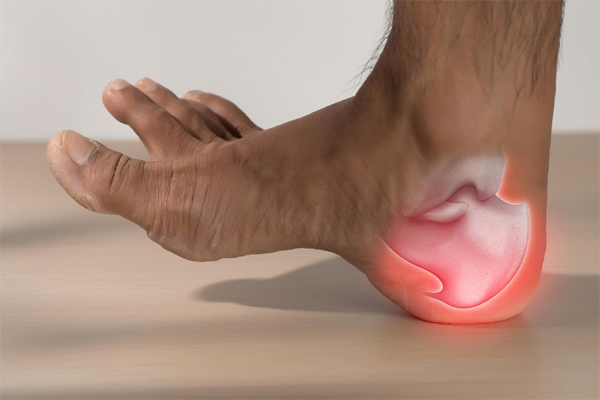Plantar Fasciitis