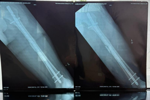 femur fracture