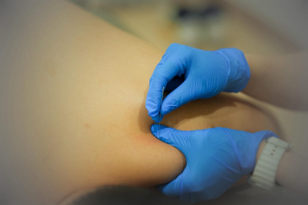 dry needling