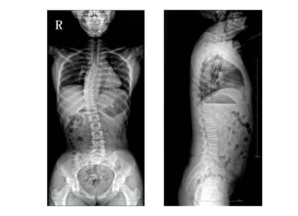 full-spine X-ray
